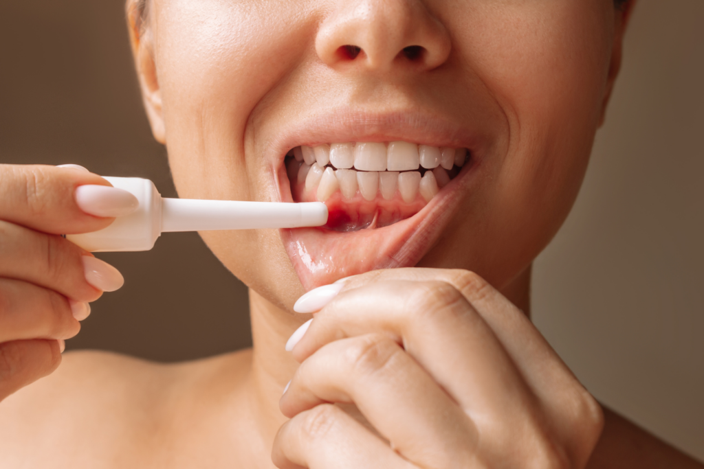 Zähne mit Bleachingmittel behandeln