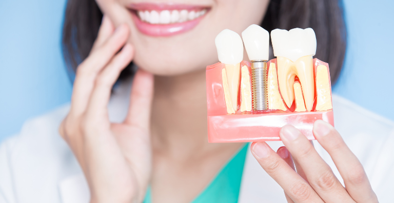 Zahnärztin hält Muster für Implantate in der Hand