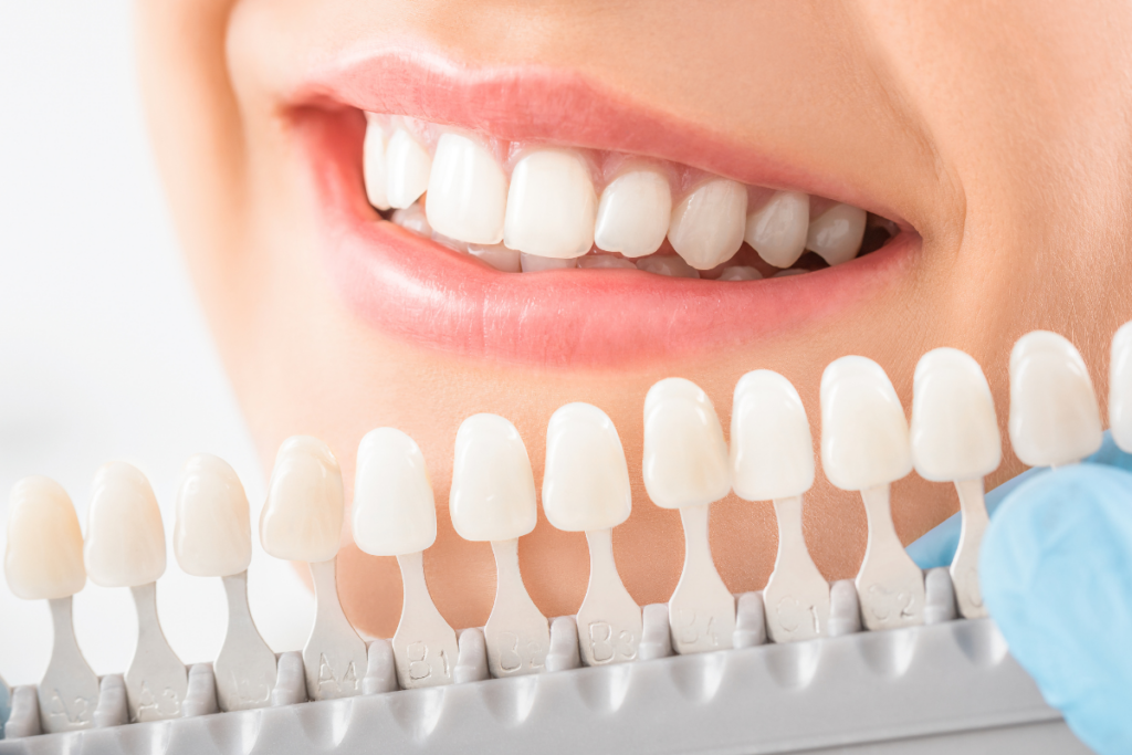 Zähne aufhellen nach Stufen. Strahlendes Lächeln Zahnreihe sauber